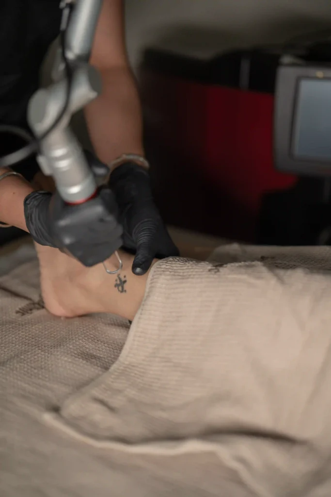 TATTOO REMOVAL